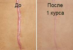 рубец до и после операции