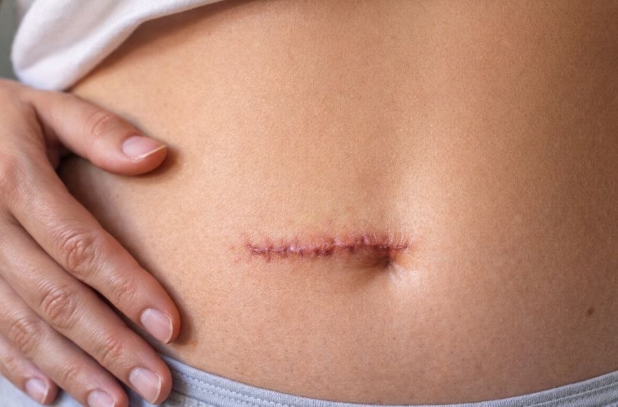 Особенности операции по удалению аппендицита