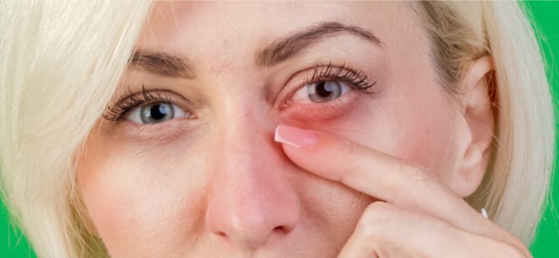 Причины и лечение красных кругов под глазами