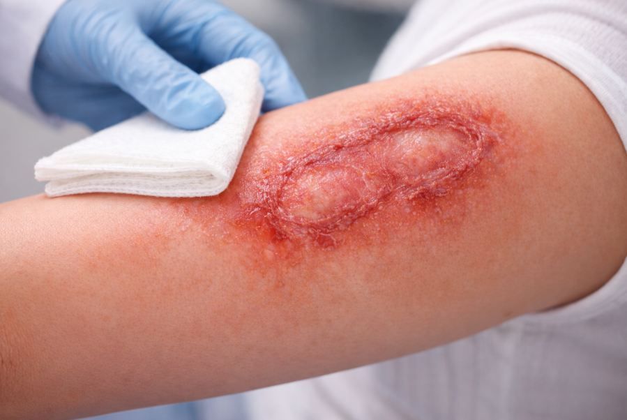 Лечение и восстановление кожи после термического ожога