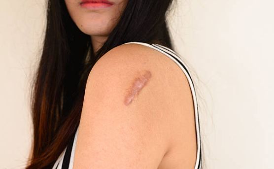 Основные причины и методы лечения фиброза на рубцах