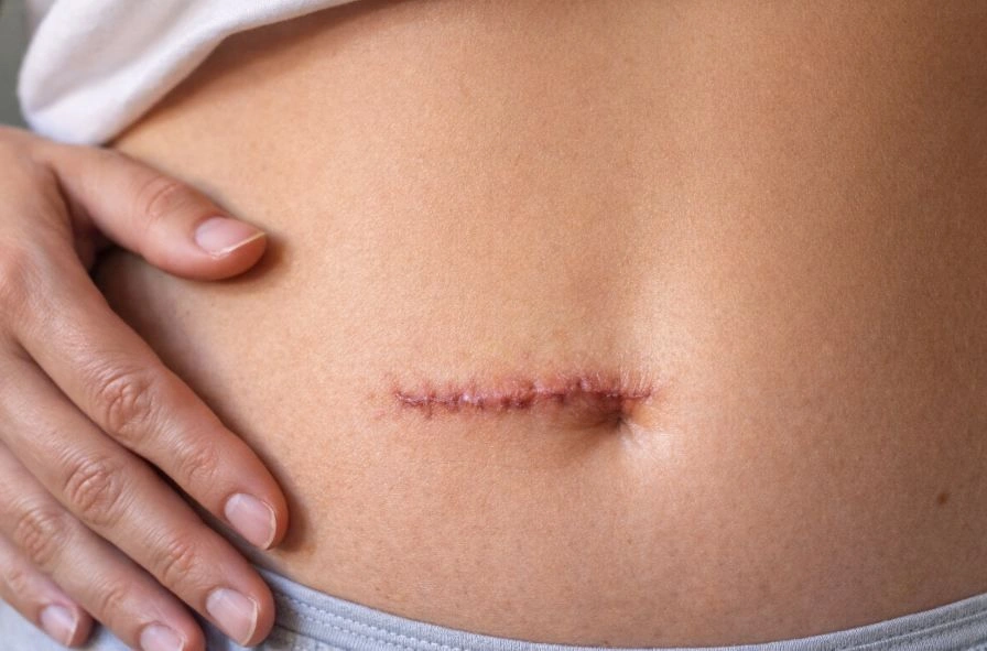 Особенности операции по удалению аппендицита