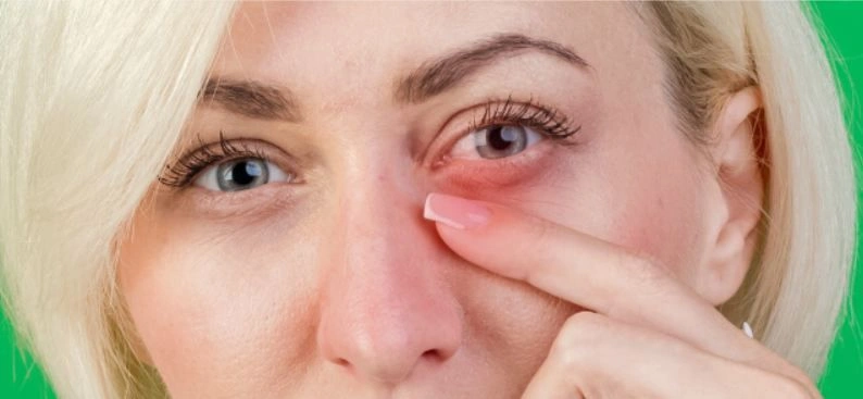 Причины и лечение красных кругов под глазами