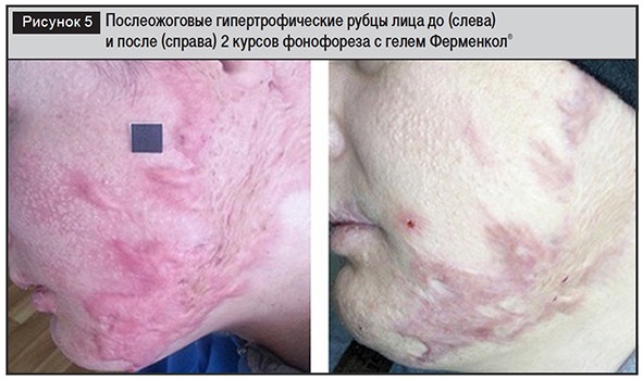 послеожоговые рубцы на лице до и после лечения