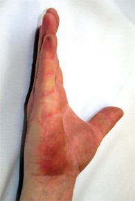 рука после лечения Ферменколом