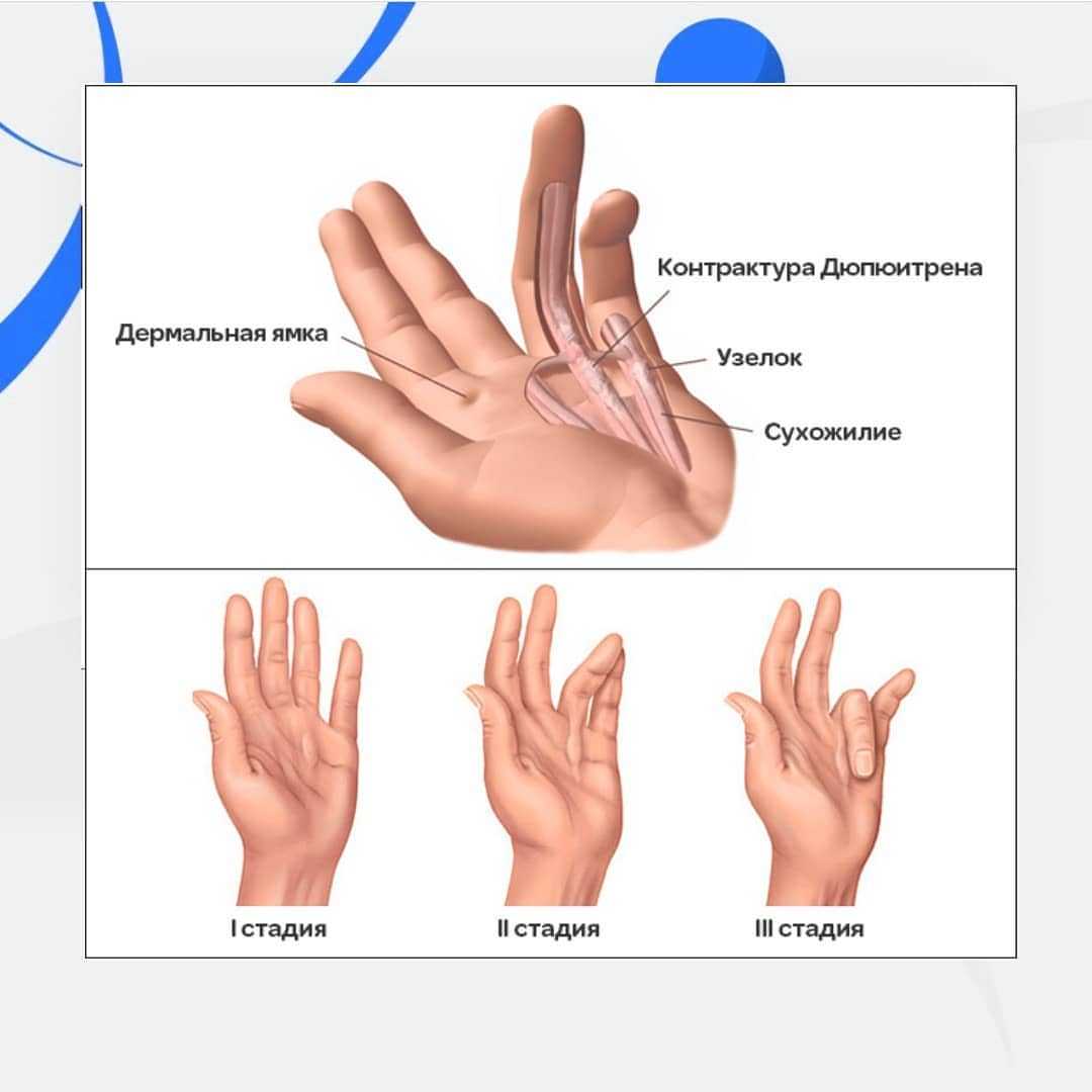 Разработать пальцы после. Заболевание кисти контрактура Дюпюитрена. Ладонный фиброматоз (контрактура Дюпюитрена). Контрактура Дюпюитрена начальная стадия. Стадии заболевания контрактуры Дюпюитрена.