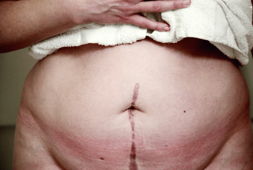 Швы после родов: уход и лечение, виды швов