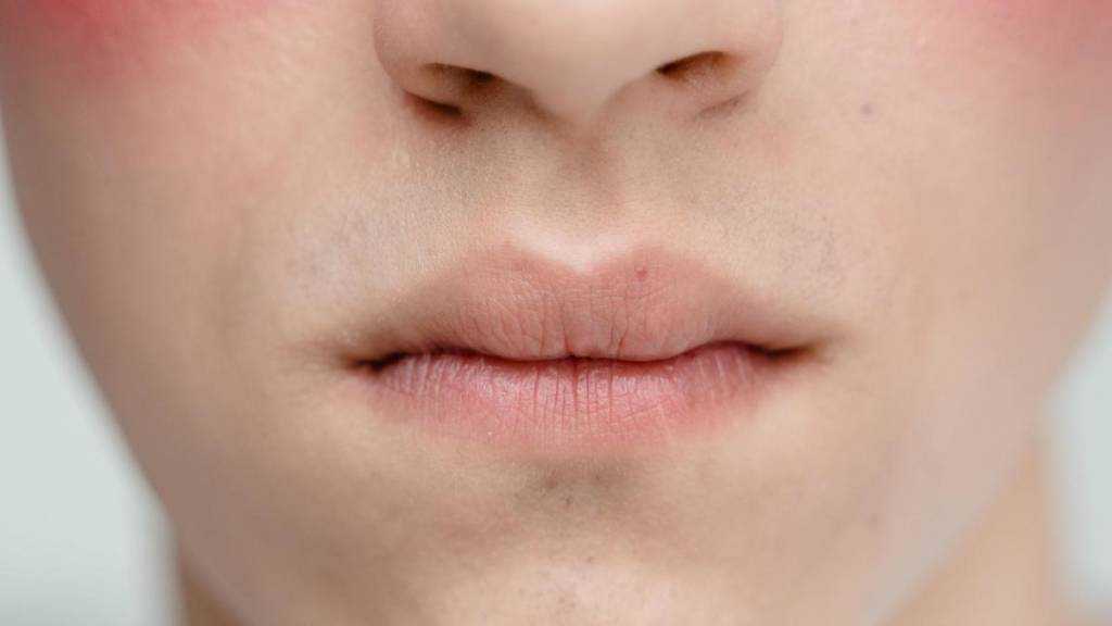 шрам после заячьей губы