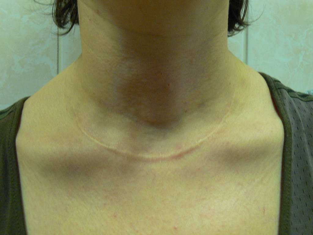 рубец после операции на щитовидной железе