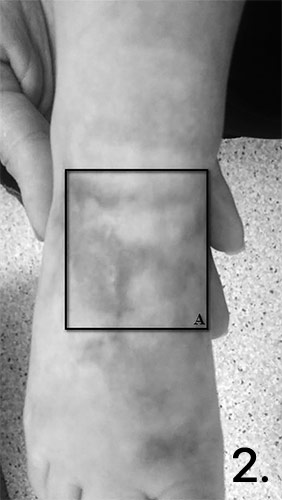 Ферментативная терапия послеожоговых рубцов кожи у детей раннего возраста